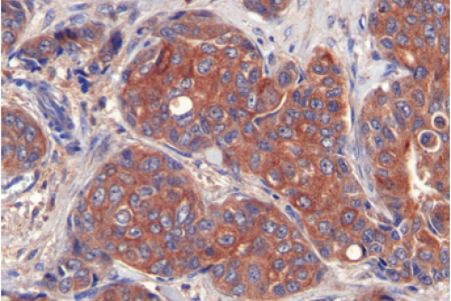 Breast tumours have high levels of LIPG expression (F Slebe, IRB Barcelona)