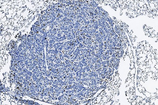 Tumor de pulmó tenyit per marcar cèl·lules en proliferació (marró) (IRB Barcelona)