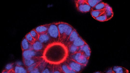 Organoides tumorals (mini-tumors de còlon) derivats de pacients. En blau, nuclis cel·lulars; en vermell, membranes cel·lulars (Imatge: Enza Lonardo, IRB Barcelona)