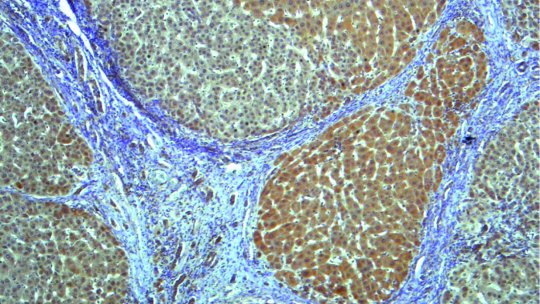Mostra de teixit humà de fetge amb cirrosi, on canvis en l'estructura i alta expressió de CPEB4 es poden veure en el nòduls de regeneració (IRBBarcelona/IDIBAPS)