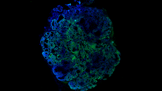 Colon cancer stem cells, in green (G. Turon, IRB Barcelona)