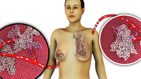 Il.lustració sobre la metástasi de càncer de mama al pulmó (©  Lab R Gomis)
