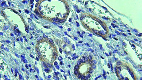 Vasos patològics (cercles blancs), amb abudant expressió de proteïna CEPB4, en un teixit cirròtic (IRB Barcelona/IDIBAPS)
