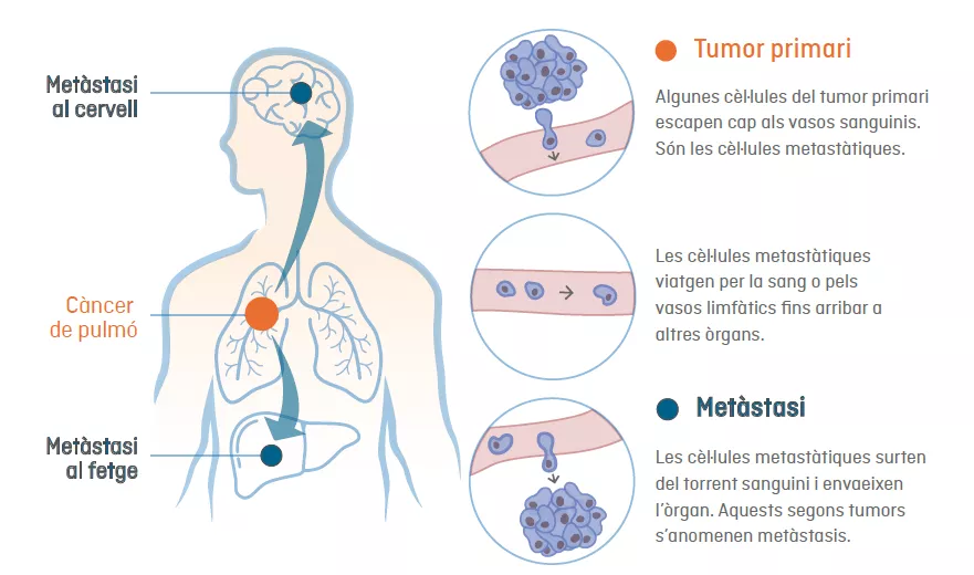 Infografia de com es genera la metàstasi: expansió de les cèl·lules canceroses d'un tumor primari a altres òrgans vitals del cos