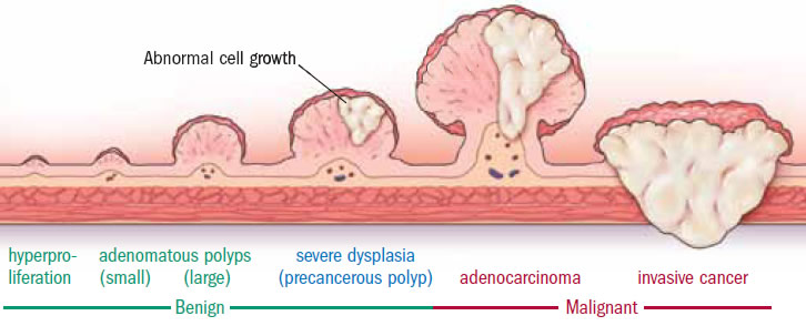 TransiciÃ³n de tumores benignos o pÃ³lipos a tumores malignos. Los pÃ³lipos se mantienen localizados en la superficie del tejido, mientras que los tumores malignos invaden las capas inferiores. Fuente: https://www.health.harvard.edu/diseases-and-conditions/they-found-colon-polyps-now-what