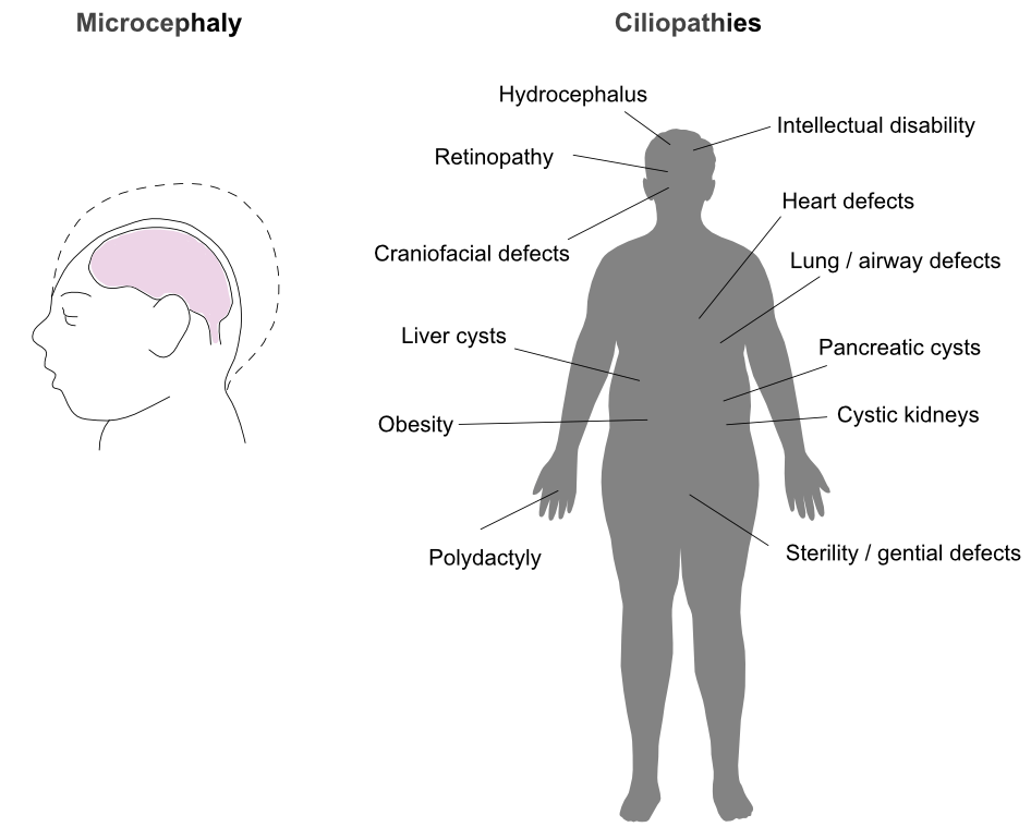 Microcephaly Ciliopathies