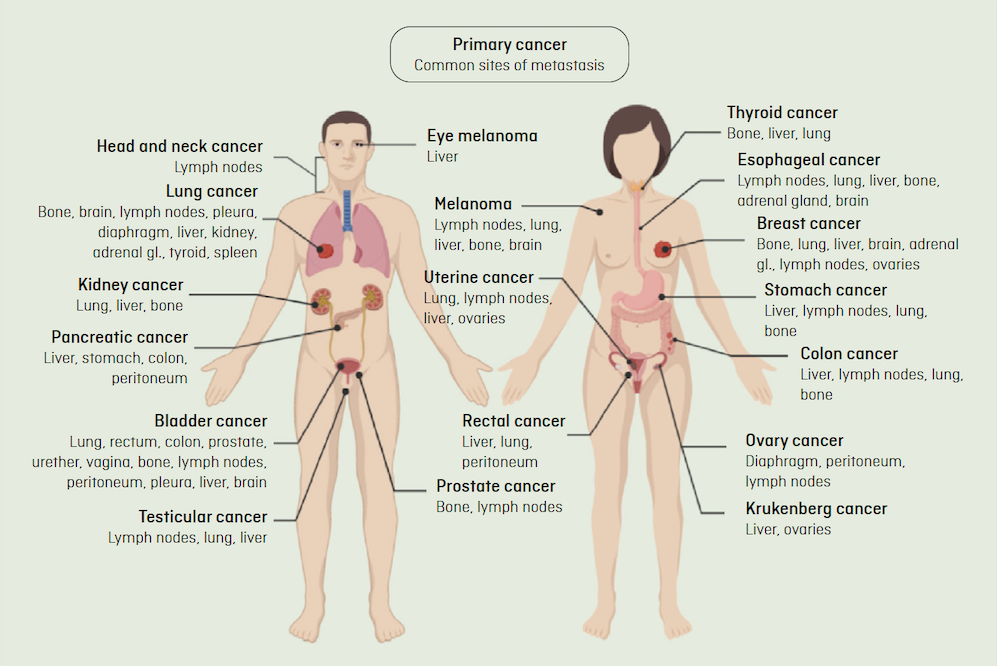 Picture with common vital organs affected by metastasis depending on where the primary tumour is, broken down by the male and female bodies