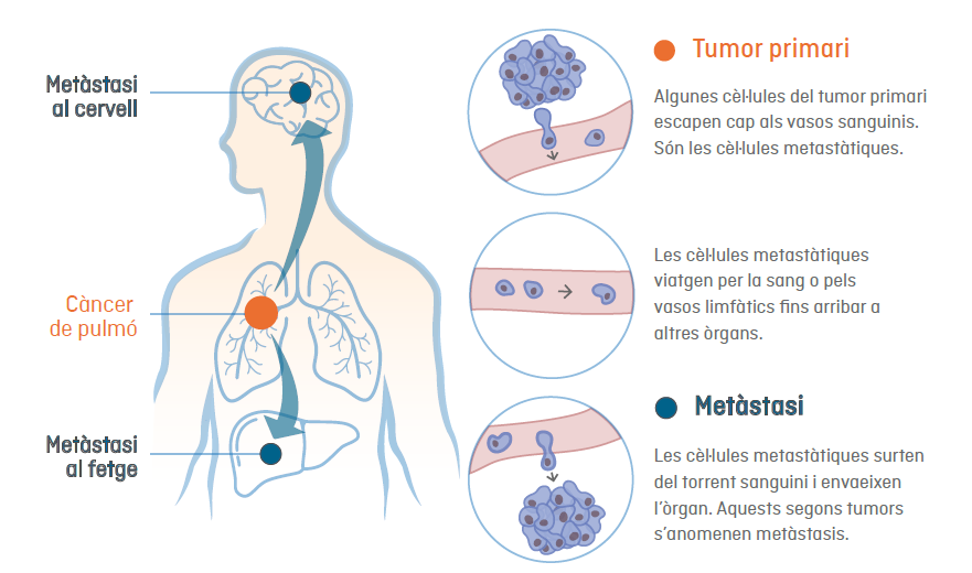 Infografia de com es genera la metàstasi: expansió de les cèl·lules canceroses d'un tumor primari a altres òrgans vitals del cos