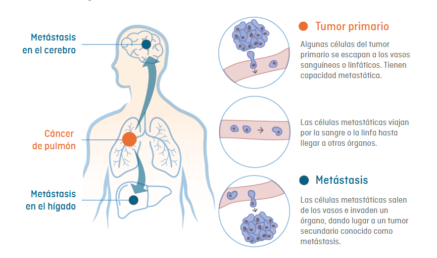 Infografía de cómo se genera la metástasis: expansión de las células cancerosas de un tumor primario a otros órganos vitales del cuerpo