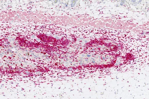 Immune cell infiltrate (in deep red) around senescent cancer cells (large nuclei marked in blue). 