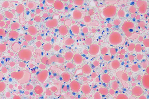 Tinción Oil Red O en secciones de hígado de ratón. Muestran la esteatosis del hígado (hígado graso), con acumulación de grasas, gotas de lípidos, (en rojo) dentro de las células. En azul, los núcleos celulares. (C Maíllo, IRB Barcelona).