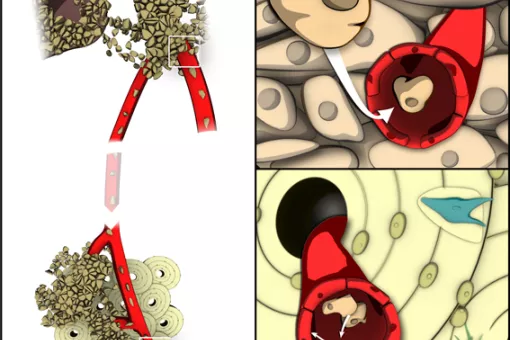 Gráfico de metástasis de un tumor primario de mama a huesos (Autor: Formas Naturales para Inbiomotion)