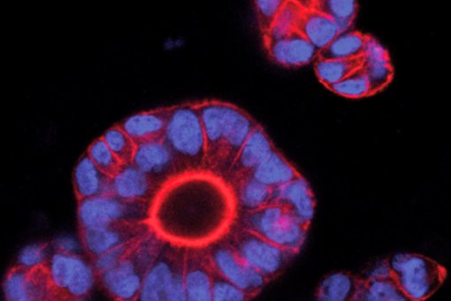 Organoides tumorals (mini-tumors de còlon) derivats de pacients. En blau, nuclis cel·lulars; en vermell, membranes cel·lulars (Imatge: Enza Lonardo, IRB Barcelona)