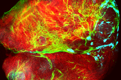 Tumor (rojo) cubierto por colágeno (verde) que está siendo depositado por células del sistema inmune (cian). (Imagen: Mariana Muzzopappa, IRB Barcelona)