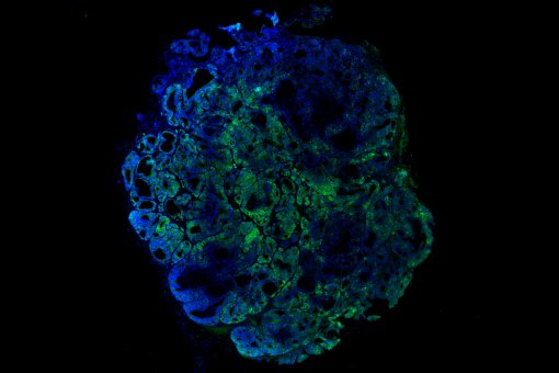 Càncer de còlon derivat de pacient, trasplantat en ratolí, amb el gen LGR5 modificat amb proteína verda fluorescent (EGFP) per poder fer el seguimient de les cèl·lule mare tumorals (imatge: G. Turon, IRB Barcelona)