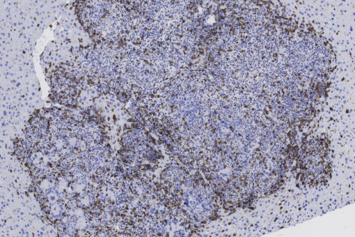 La imatge mostra un tumor metastàtic de còlon infiltrat pel sistema immune (en marró) després de la combinació de l'inhibidor de TGF-beta i immunoteràpia (Autor: Daniele Tauriello, IRB Barcelona)