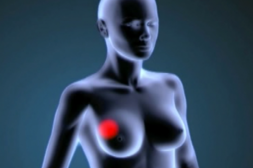 Tot i la gran varietat d'agents antitumorals, molts tractaments fallen amb el temps per a tumors sòlids en estadis avançats, inclòs el càncer de mama.