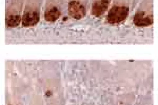Healthy intestinal crypts (upper image) maintain different cell types in their compartments. Cells located at the bottom of the crypt (lower image) in which ADAM10 is blocked (lower image) migrate to the upper cell compartment (cells in dark brown)