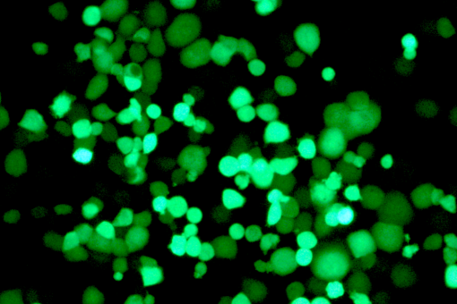 Células tumorales infectadas por el virus, que expresa una proteína fluorescente. A medida que pasan los días (quinto día en la imagen), el virus se multiplica, genera nuevos viriones que infectan más células cancerígenas.(IDIBAPS, IRB Barcelona)
