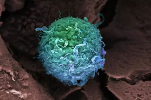 Una célula de cáncer de mama. Imagen: GETTY, El País.