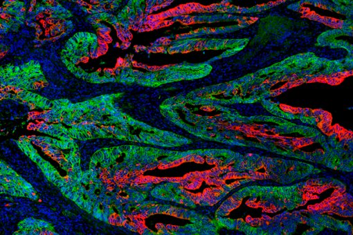 L'heterogeneïtat del tumor: cèl·lules mare del càncer (verdes) i cèl·lules diferenciades (en vermell). IRB Barcelona.