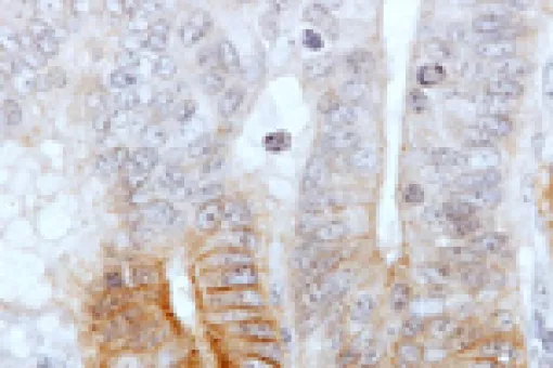 Intestinal epithelium with tumour stem cells marked in brown.