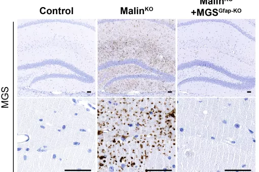 Cuerpos de Lafora en cortes de cerebro (hipocampo). Los cuerpos que se acumulan en la enfermedad desaparecen cuando se elimina la capacidad de los astrocitos de producir glucógeno.