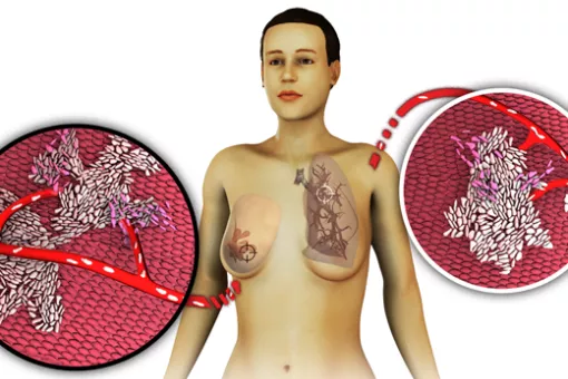 Ilustración sobre la metástasis del cáncer de mama a pulmón (©  Lab R Gomis)
