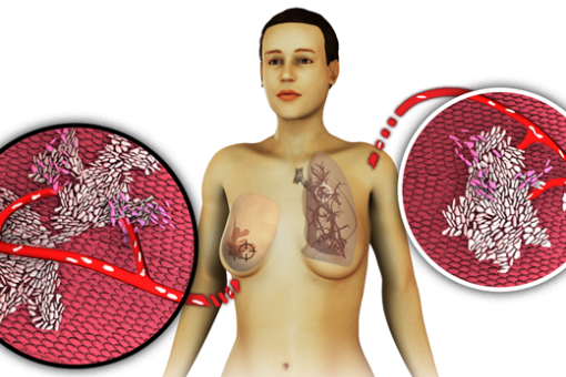 Ilustración sobre la metástasis del cáncer de mama a pulmón (©  Lab R Gomis)