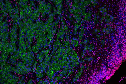 Un frente invasivo de células tumorales altamente agresivas (en verde). Imagen de microscopía confocal. Alexandra Avgustinova, IRB Barcelona.