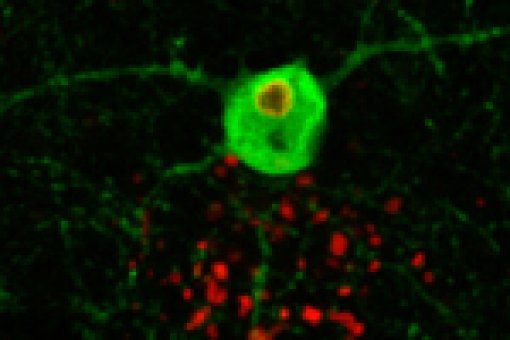 Interneuron obtained from an engineered mouse lacking the malin gene (in green) and showing the accumulation of Lafora bodies (in red).