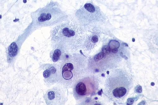 Malignant melanoma. Image: 3/24. 