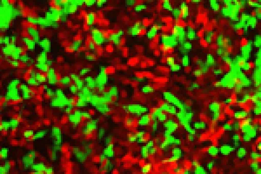 In vitro culture of colon cancer tumour cells. The tumour cells (in green) have deactivated the positional receptors and spread to invade the tissue occupied by the red cells.<br />