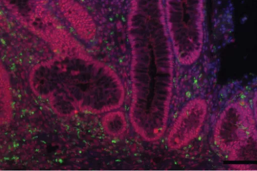 Intestine of a patient  with ulcerative colitis, a chronic inflammatory disease of the intestine. Macrophage marker is shown in green, activated p38 protein in red, and nucleus in blue. Author: Catrin Youssif, IRB Barcelona 