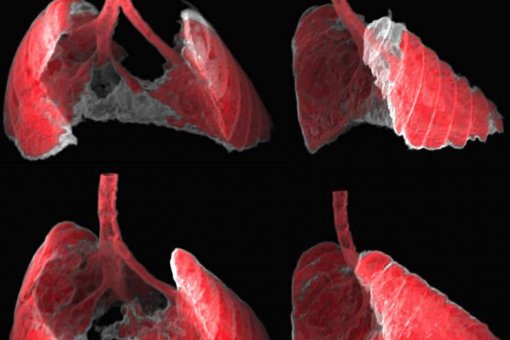 La figura mostra dues vistes, frontal i lateral, de la imatge obtinguda per TAC dels pulmons d'un ratolí amb fibrosi (zones grises) abans i després de ser tractat amb nano-teràpia dirigida a les cèl·lules senescents. (G Garaulet i F Mulero, CNIO) 