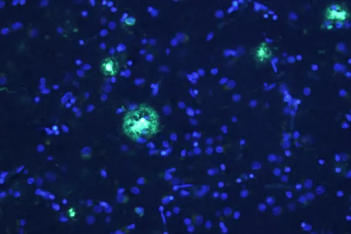Alzheimer's disease brain. In blue, neuronal bodies and in green amyloid plaques. (Author: Alberto Serrano-Pozo, Massachusetts General Hospital)