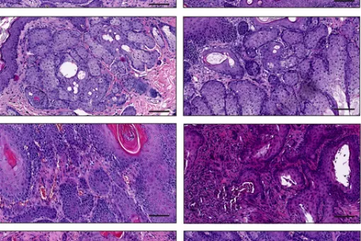 Imágenes representativas de diferentes subtipos de tumores de piel (L. Rinaldi, IRB Barcelona)