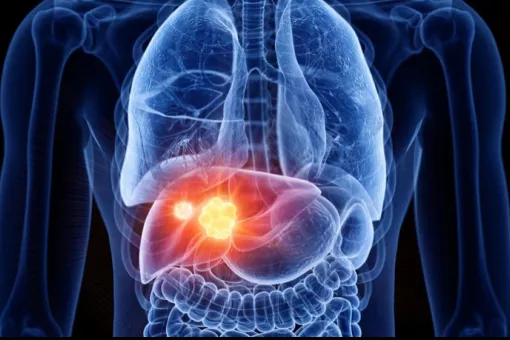 Image created by computer of a liver cancer (SEBASTIAN KAULITZKI/SCIENCE PHOT / Getty)