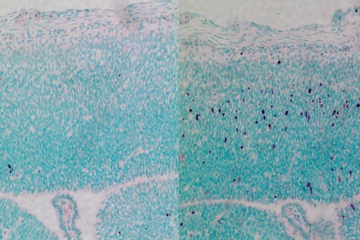 CEP63 depletion increases stem cell death in the developing mouse brain. The image on the right shows the stem dying cells in purple. The mice are born with microcephaly, a characteristic feature of Seckel Syndrome (Image: Berta Terré, IRB Barcelona)
