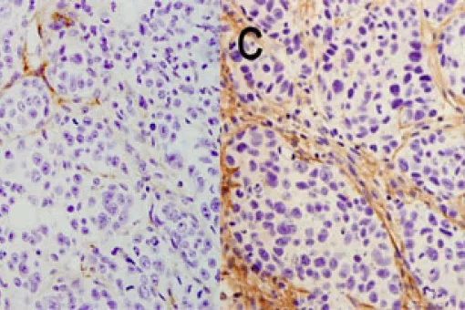 The image on the left shows how the pancreatic tumor enters remission when CEPB4 protein expression is removed while that on the right shows that tumor tissue grows in the presence of CEPB4 through the development of new blood vessels.