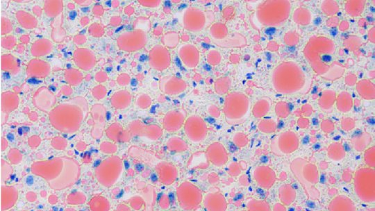 Staining of mouse liver sections showing steatosis of the liver (fatty liver), with accumulation of fat, lipid droplets (in red), within cells. Cell nuclei stain blue (C. Maíllo, IRB Barcelona).