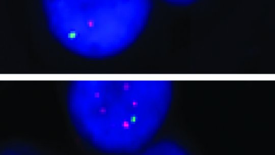 Top, breast cancer tumour cells negative for the bone metastasis marker. Bottom, breast cancer tumour cells positive for the marker (Gomis Lab, IRB Barcelona)