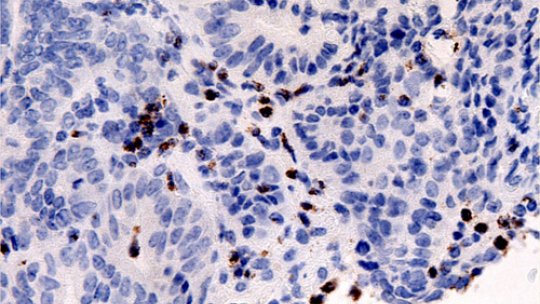 Picture of a colon tumour (Author: J Gupta, IRB)
