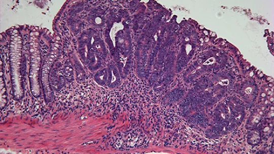 Angel R. Nebreda (left) and Jalaj Gupta in the lab. They are the senior and first authors respectively of the Cancer Cell study on colorrectal cancer (Image by IRB)