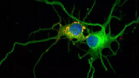 Image obtained by confocal microscopy. The accumulation of glycogen (yellow and red) in neurons caused their degradation and cell suicide ensues. (c)IRB Barcelona