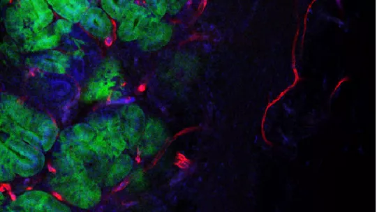 Imagen de microscopía de un tumor de colon (Imagen: Alexandre Calon, IRB Barcelona)
