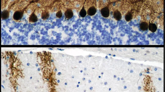 Imágenes comparativas de microscopia. Abajo, corte de cerebelo sano de ratón. Arriba, efectos de la acumulación de glucógeno en las neuronas. (Jordi Duran. IRB Barcelona)