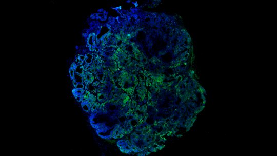 Cáncer colorectal derivado de paciente e implantado en ratón con el gen LGR5 modificado con proteína verde fluoresecente (EGFP) para poder seguir el comportamiento de las células madre tumorales (Imagen, G. Turon, IRB Barcelona)