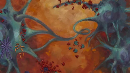 Drawing of the neuronal damage that occurs in Alzheimer's disease. The red circles show the amyloid beta molecules (Author & copyrights: Antònia Casanovas)