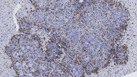 La imatge mostra un tumor metastàtic de còlon infiltrat pel sistema immune (en marró) després de la combinació de l'inhibidor de TGF-beta i immunoteràpia (Autor: Daniele Tauriello, IRB Barcelona)